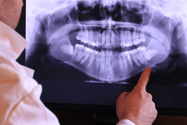 Best Emergency Wisdom Tooth Extraction in Charlotte Park, FL