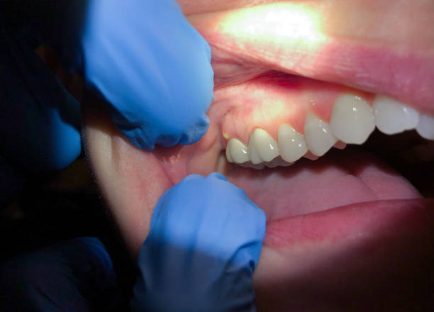Best Lost Filling or Crown Replacement in Charlotte Park, FL